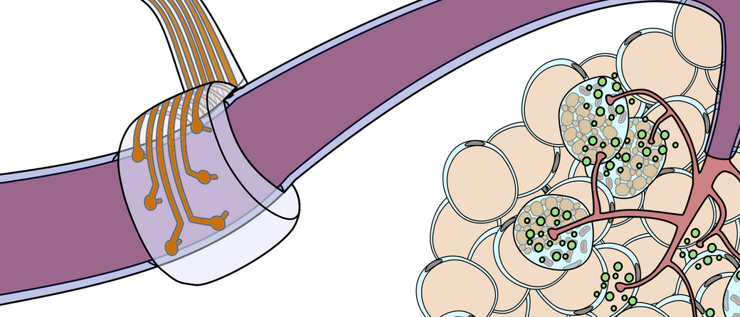 Das Bild zeigt eine Flexible Elektrode, die mit einem Nervenstrang verbunden ist. Der Nervenstrang ist als violetter Schlauch dargestellt, die Elektrode besteht aus sechs kreisförmigen Metallteilen, von denen jedes eine kleine Spizte hat, die in den Nerv hineinragt. Zu jeder Elektrode führt eine metallische Stromleitung. Die sechs Leitungen verlaufen parallel in einem transparenten Band. 