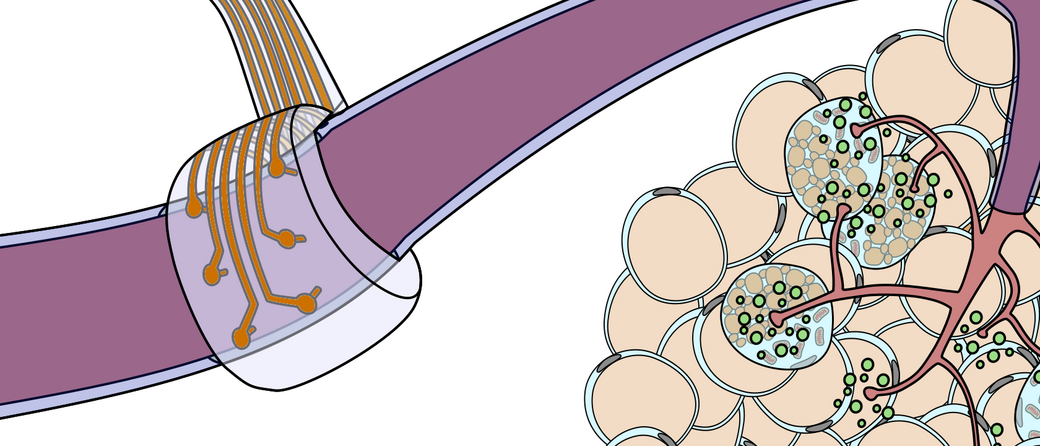 The image shows a flexible electrode that is connected to a nerve. The nerve is represented as a purple colored tube. The electrode consists of six circular metal parts each equipped with a small tip that goes into the nerve. A metallic conducting track leads to any of these electrode ends. The tracks are embedded in a transparent band. 
