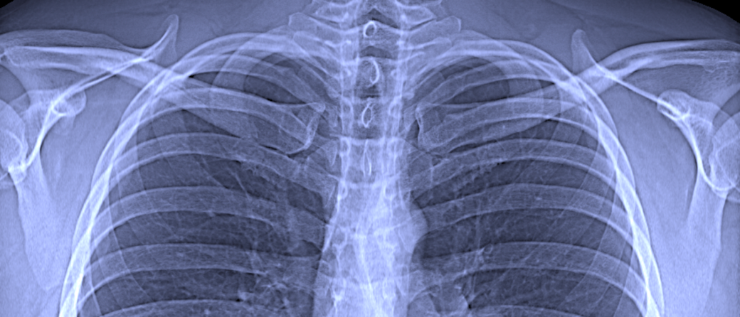 Ausschnitt aus einer konventionellen Röntgenaufnahme des Brustkorbs Bild: Franz Pfeiffer / TUM