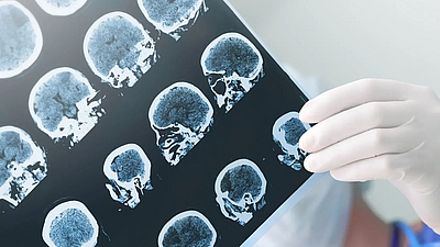 The time of a stroke is currently usually determined using CT scans. The darker the damaged region, the longer ago the stroke occurred. A new AI-supported procedure can determine the time much more precisely. Image: sudok1 / istockphoto.com