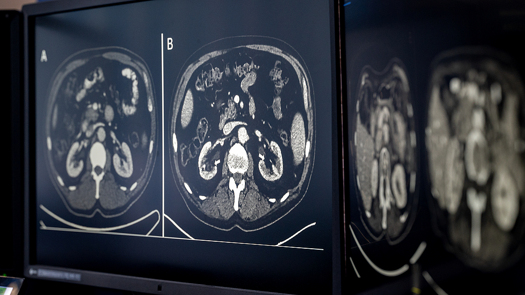 CT scans CT scans of kidneys. Image: Astrid Eckert / TUM