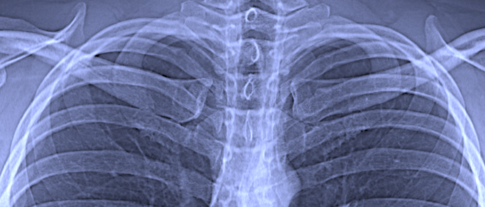 Ausschnitt aus einer konventionellen Röntgenaufnahme des Brustkorbs Bild: Franz Pfeiffer / TUM 
