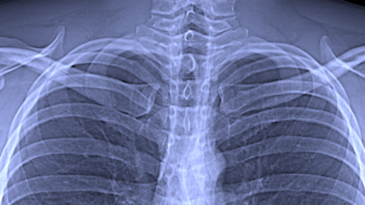 Ausschnitt aus einer konventionellen Röntgenaufnahme des Brustkorbs Bild: Franz Pfeiffer / TUM 