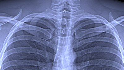 Conventional chest x-ray Image: Franz Pfeiffer / TUM 