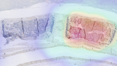 In the right half of this tissue section, engineered immune cells known as CAR T cells are attacking tumor tissue. A new method makes it possible to visualize them in the body using PET imaging, as shown here in the superimposed image. Image: Volker Morath / TUM
