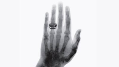 Eines der ersten Röntgenbilder, die jemals aufgenommen wurden. Es zeigt die Hand des Anatomen Albert von Kölliker und wurde im Rahmen des ersten öffentlichen Vortrags über Röntgenstrahlen am 23.01.1896 verwendet (Quelle: Röntgen-Kuratorium Würzburg e.V.)