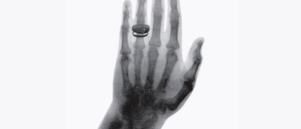 Eines der ersten Röntgenbilder, die jemals aufgenommen wurden. Es zeigt die Hand des Anatomen Albert von Kölliker und wurde im Rahmen des ersten öffentlichen Vortrags über Röntgenstrahlen am 23.01.1896 verwendet (Quelle: Röntgen-Kuratorium Würzburg e.V.)
