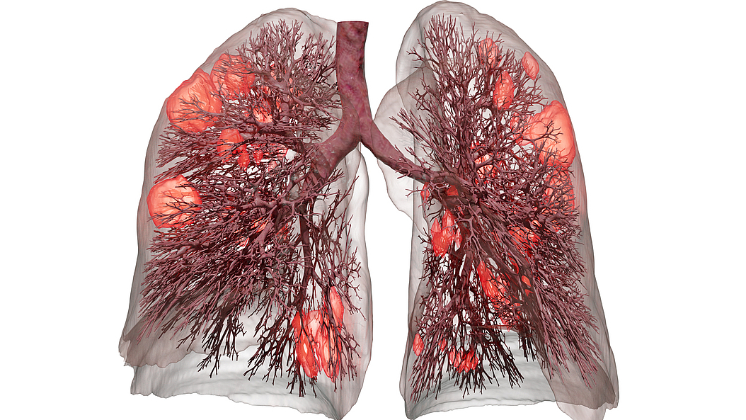 Aus den Daten eines Computer-Tomogramms kann das Programm mithilfe künstlicher Intelligenz den aktuellen Zustand der Patientenlunge berechnen. Das Bild zeigt eine durch eine Covid-19-Infektion (orange Bereiche) geschädigte Lunge. (Bild: J. Richter/TUM)