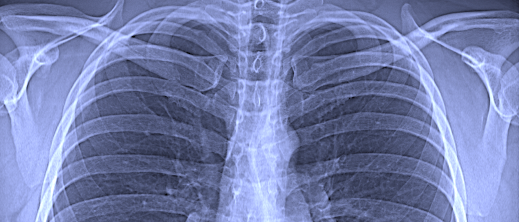 Ausschnitt aus einer konventionellen Röntgenaufnahme des Brustkorbs Bild: Franz Pfeiffer / TUM