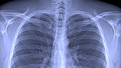 Conventional chest x-ray Image: Franz Pfeiffer / TUM
