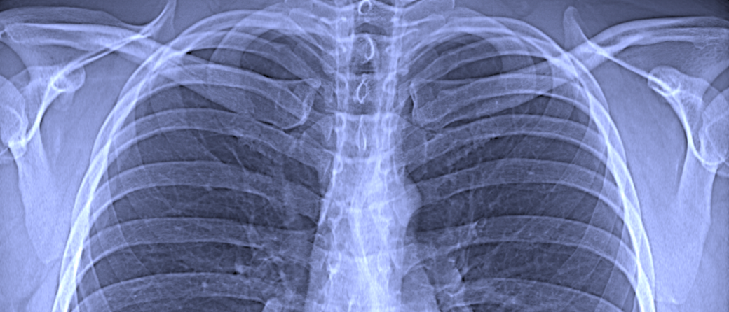 Conventional chest x-ray Image: Franz Pfeiffer / TUM