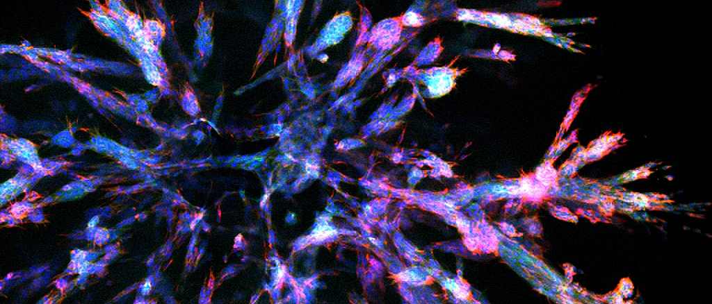 Stained pancreatic cancer organoid. The newly developed organoids mimic the varied and complex structures of pancreatic cancer in the body. Image: Aris Papargyriou / TUM