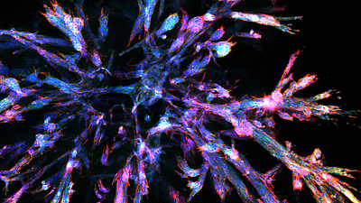 Stained pancreatic cancer organoid. The newly developed organoids mimic the varied and complex structures of pancreatic cancer in the body. Image: Aris Papargyriou / TUM