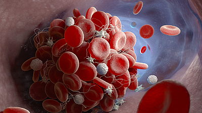 Bei einer Sars-CoV-2 Infektion lagern sich Thrombozyten an den Blutplättchen an. Dadurch entstehen Zellaggregate im Blutkreislauf.